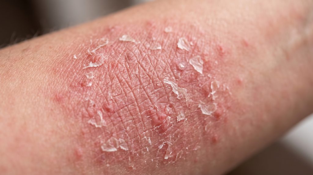 Área da pele com vermelhidão, ressecamento intenso e descamação, características comuns da dermatite atópica durante uma crise inflamatória que causa coceira e irritação.