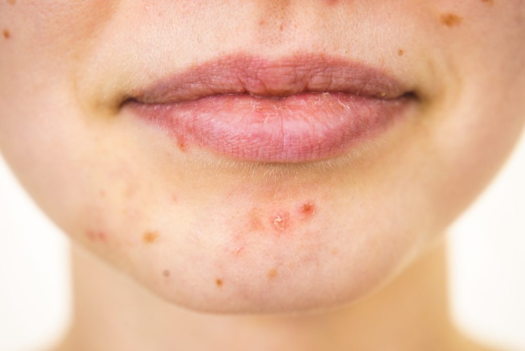 Rosto com manchas na pele, pequenas lesões e alterações de pigmentação na região do queixo e ao redor da boca, ilustrando sinais que podem ser comuns, mas que em alguns casos merecem avaliação dermatológica.