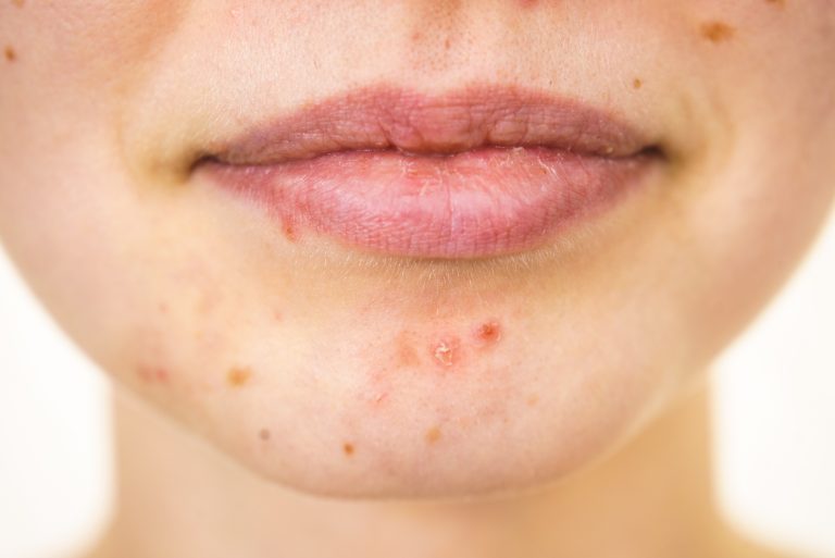 Rosto com manchas na pele, pequenas lesões e alterações de pigmentação na região do queixo e ao redor da boca, ilustrando sinais que podem ser comuns, mas que em alguns casos merecem avaliação dermatológica.