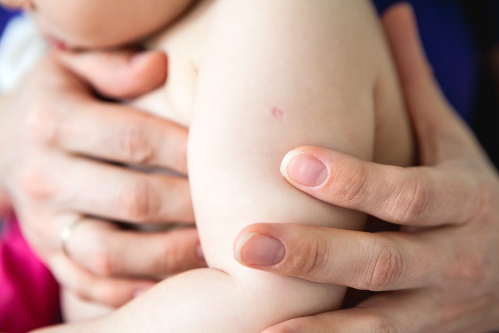 Braço de um bebê com a marca característica da Vacina BCG, ilustrando a proteção contra formas graves de tuberculose nos primeiros meses de vida.