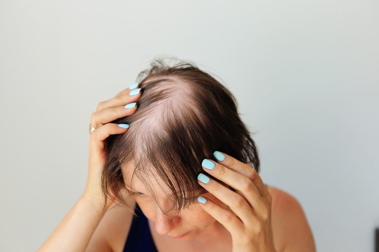 Mulher observa áreas de rarefação dos fios no couro cabeludo, ilustrando a queda de cabelo e possíveis sinais que merecem avaliação.